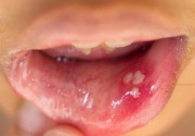 Kanker mulut intai pengguna gigi palsu 