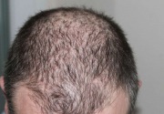 Penyebab dan pengobatan mengatasi penipisan rambut
