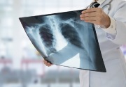 Penderita penyakit paru obstruktif kronik di Indonesia mencapai 9,2 juta orang