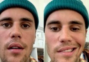 Wajah Justin Bieber lumpuh sebelah karena RHS: Berikut penjelasannya