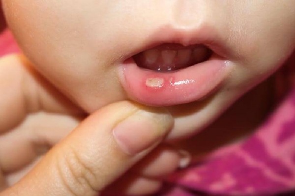 Penyebab sariawan di bibir