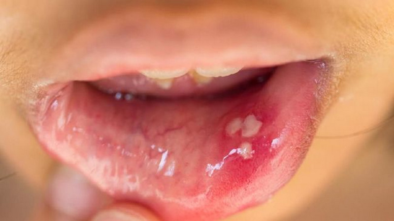 Kanker mulut intai pengguna gigi palsu 