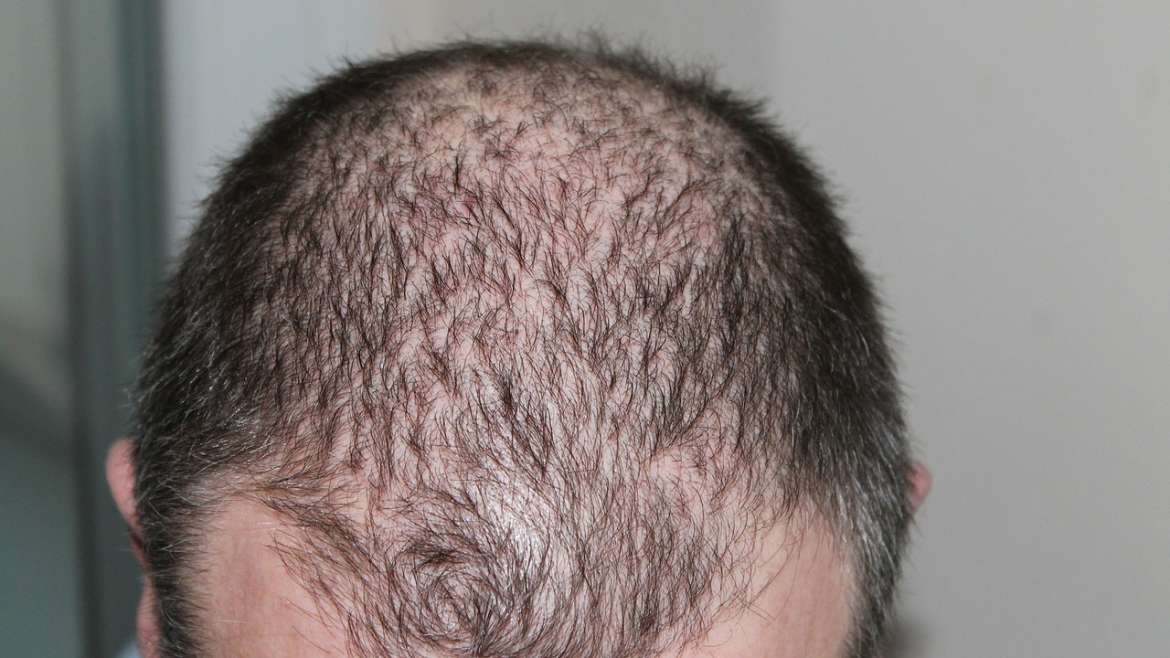 Penyebab dan pengobatan mengatasi penipisan rambut
