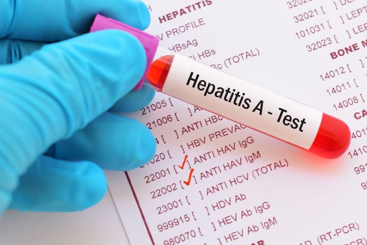 Komisi X DPR minta pemerintah gencarkan penelitian hadapi hepatitis misterius